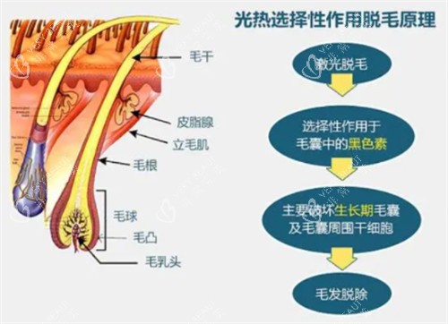 光子脱毛的原理