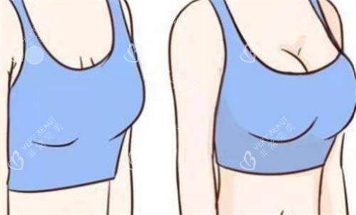 隆胸前后对比图