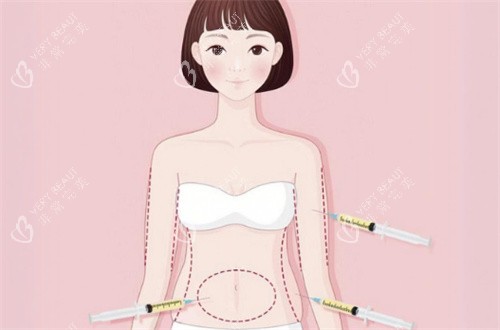吸脂部位