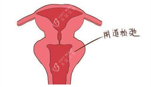 阴道松弛动画演示图