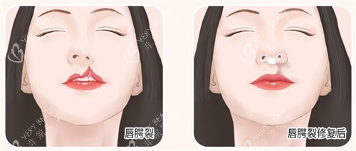 唇腭裂修复