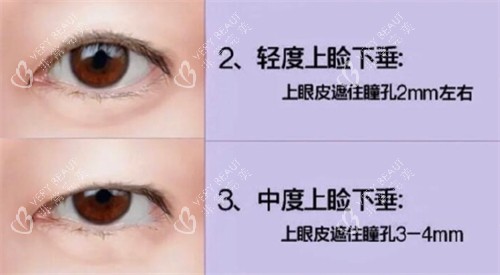 上睑下垂自测图