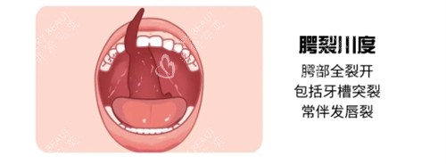 三度唇腭裂