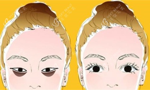 眼袋明显对比图