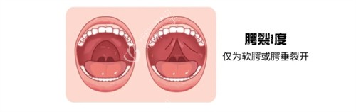 一度唇腭裂