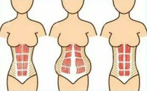 腹壁成形手术卡通示意图
