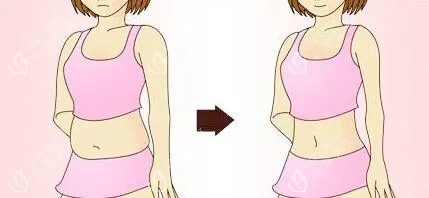 腰腹吸脂对比卡通图
