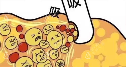 吸脂过程动画展示图