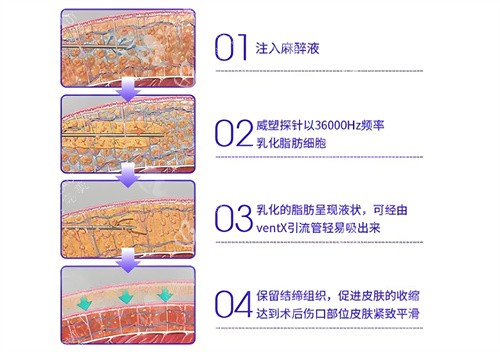 威塑吸脂手术步骤演示动画图