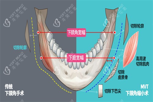下颌角手术宣传图