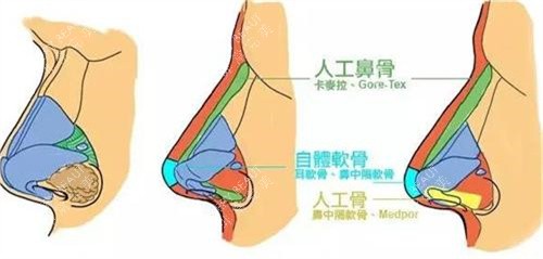 隆鼻手术对比