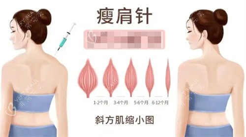 瘦身针瘦斜方肌