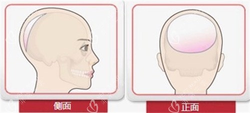 后脑勺整形手术