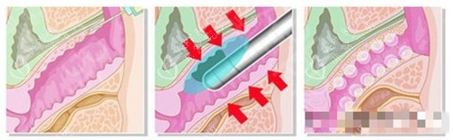 菲蜜丽过程卡通图