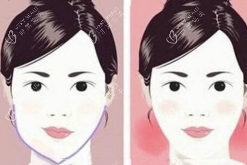脸型不对称矫正前后对比图