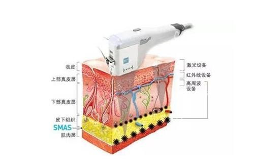 激光祛红血丝示意图