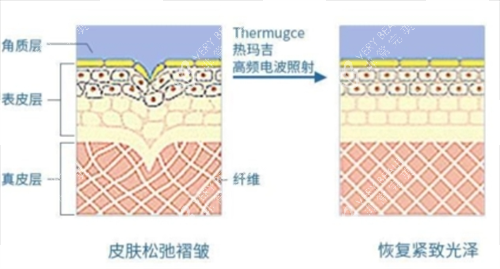 热玛吉作用在皮肤上皮下组织展示