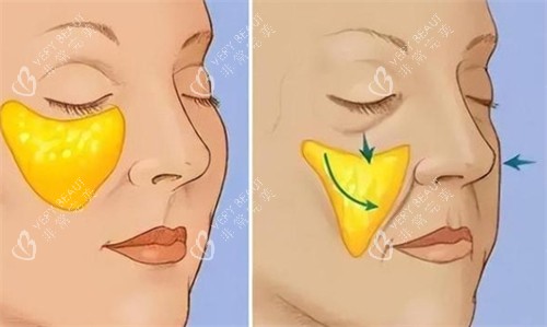 面部苹果肌提升前后对比