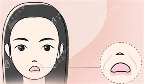 法令纹