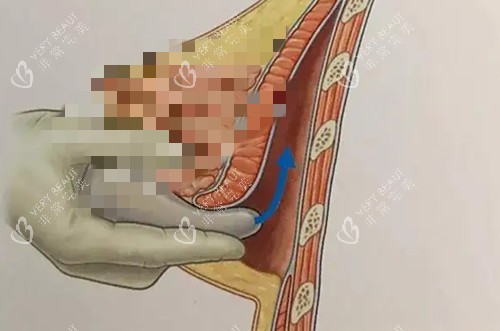 假体隆胸手术卡通示意图