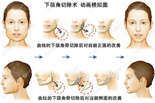 下颌角切除术动画模拟图