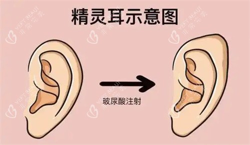精灵耳注射