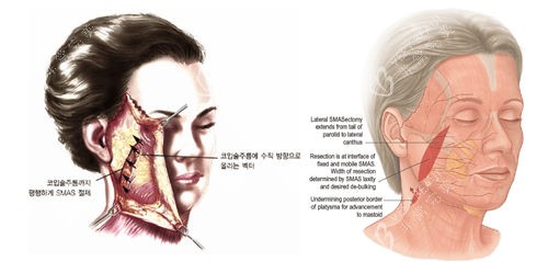 北京加减美v9手术原理逐层分离