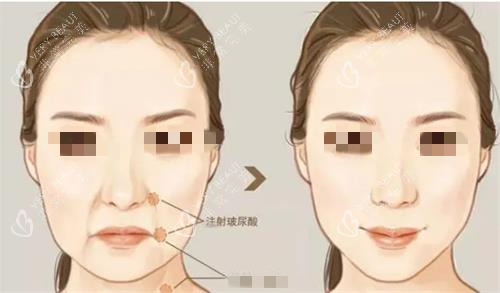 注射玻尿酸前后对比图