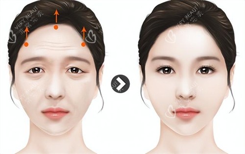 拉皮提眉手术演示动画图