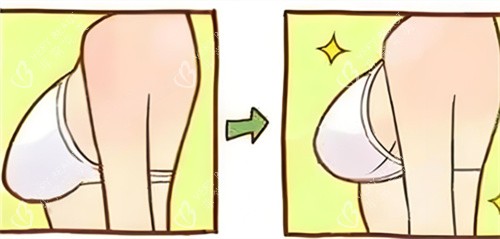胸部缩小术前后对比动画图