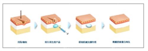 童颜针注射前后对比图解
