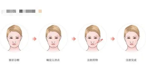 骸肌放松注射过程示意图