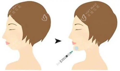 注射垫下巴前后的区别