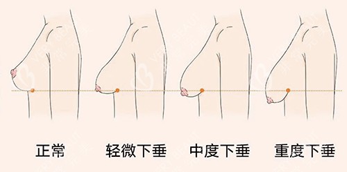 乳房下垂标准