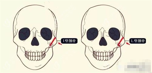 颧骨整形图片