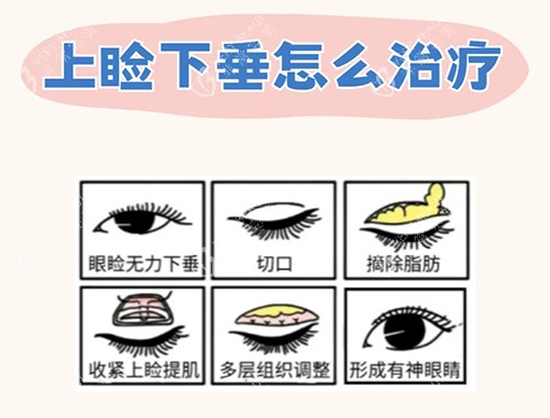 上睑下垂治疗漫画图