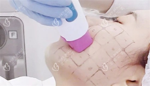 面部热玛吉治疗