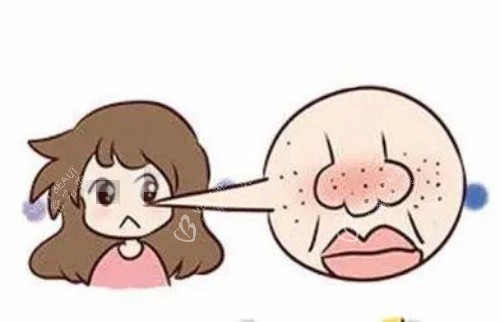 鼻子部位毛孔粗大示意图