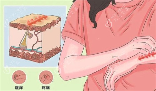 疤痕