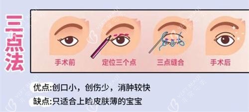 双眼皮手术三点法动画演示图