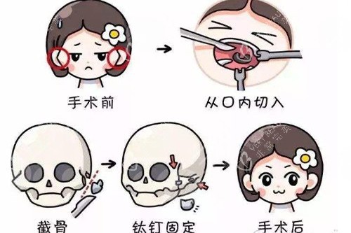 颧骨整形手术卡通形象图