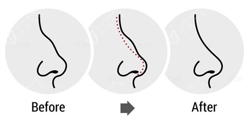 驼峰鼻子的改变过程图