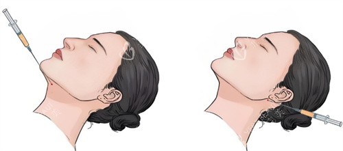 双下巴注射