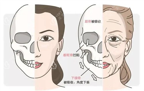 年轻和老化的面部骨骼
