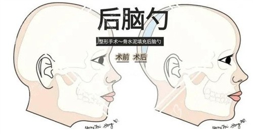 后脑勺填充手术前后