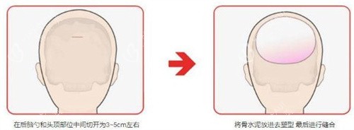 后脑勺整形手术图
