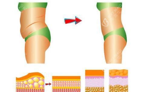 腰腹吸脂对比图