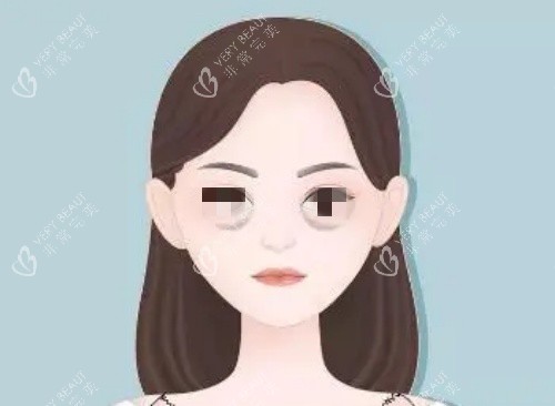 泪沟漫画示意图