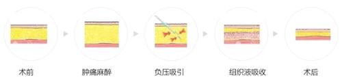 吸脂过程图解