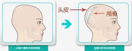 后脑勺手术